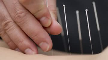 Imagem Psicólogos não podem praticar acupuntura, decide STJ