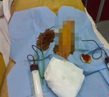 Imagem Camamu: homem dá entrada em hospital após 72 horas com pênis ereto