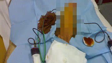 Imagem Camamu: homem dá entrada em hospital após 72 horas com pênis ereto