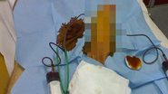 Imagem Camamu: homem dá entrada em hospital após 72 horas com pênis ereto