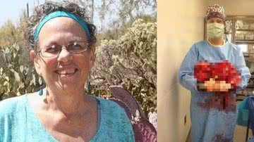 Imagem Tumor de 21 kg é retirado de mulher em cirurgia de 10 horas