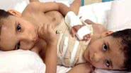 Imagem Riacho de Santana: irmãos siameses se preparam para cirurgia de separação