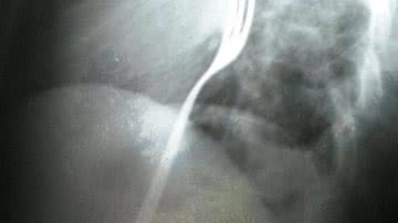 Imagem Bêbado engole garfo em aposta e acaba no hospital