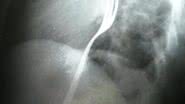 Imagem Bêbado engole garfo em aposta e acaba no hospital