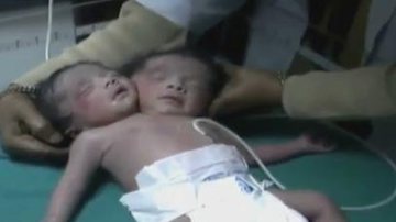 Imagem Nasce bebê com duas cabeças. Veja vídeo