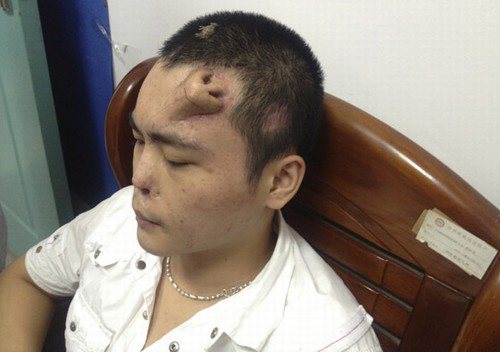 Imagem Chinês faz cirurgia e deixa nariz na testa. Veja foto