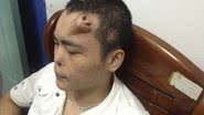 Imagem Chinês faz cirurgia e deixa nariz na testa. Veja foto