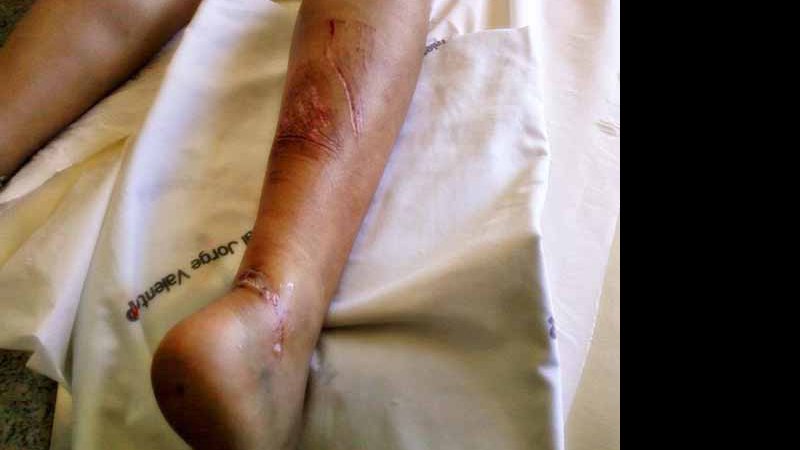 Imagem Jovem atingida por mármore no Iguatemi vai passar por cirurgia