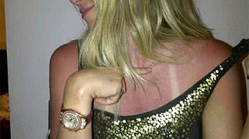 Imagem Susana Werner exagera no sol e fica um pimentão