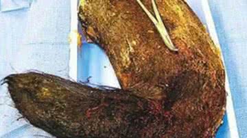 Imagem Garota tinha 2 kg de cabelo no estomago