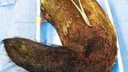 Imagem Garota tinha 2 kg de cabelo no estomago