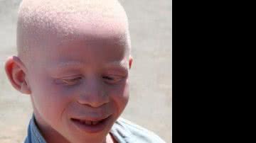 Imagem Albinos farão exames de pele gratuitos