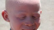 Imagem Albinos farão exames de pele gratuitos