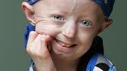 Imagem Menina comemora 13 anos com doença rara