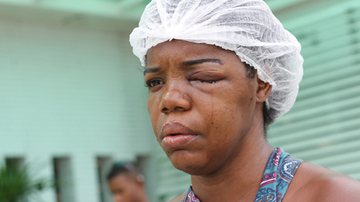 Imagem Mulher fica cega após tomar golpe de cassetete de policial