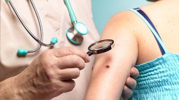 Imagem Câncer: Nova droga contra melanomas duplica sobrevida