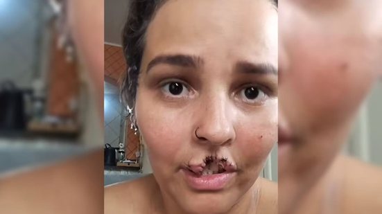 Imagem Marido manda matar chow-chow que arrancou lábio de mulher