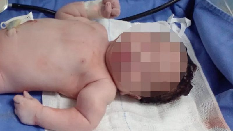 Bahia: Bebê tem o braço quebrado durante parto em Salvador; pais alegam erro médico