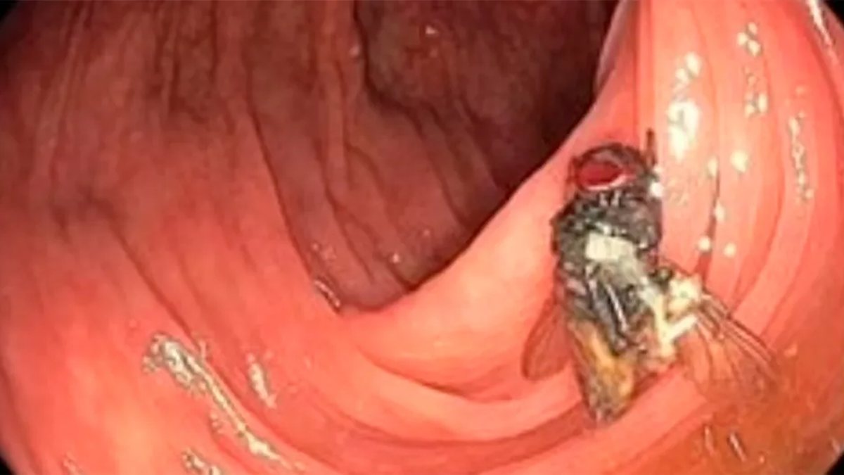 Noticias: Se encontró una mosca viva en los intestinos de un paciente. ¿Es posible que se infecte con la enfermedad?  entender este problema