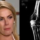 Hickmann conta que Alexandre fechou uma porta de correr em seu braço - Reprodução