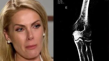 Hickmann conta que Alexandre fechou uma porta de correr em seu braço - Reprodução