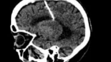 Reprodução/Secretaria de Saúde da Sakhalin