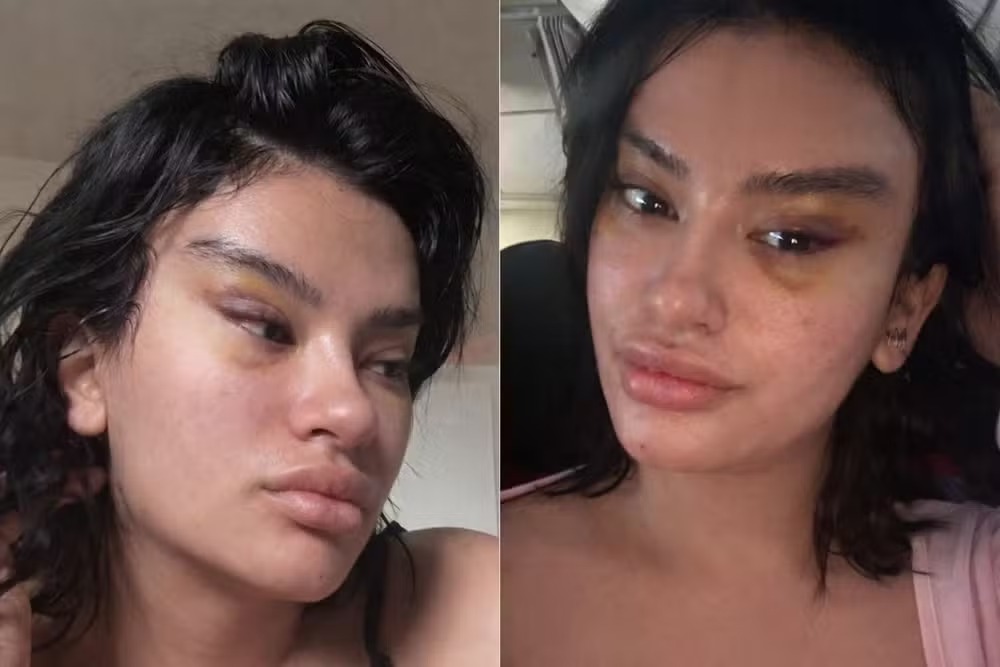 Influencer passa por cirurgia estética para reduzir a idade — Foto: @juju.brazil | CO ASSESSORIA
