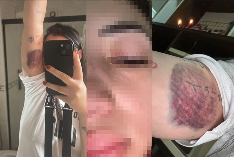 hematomas