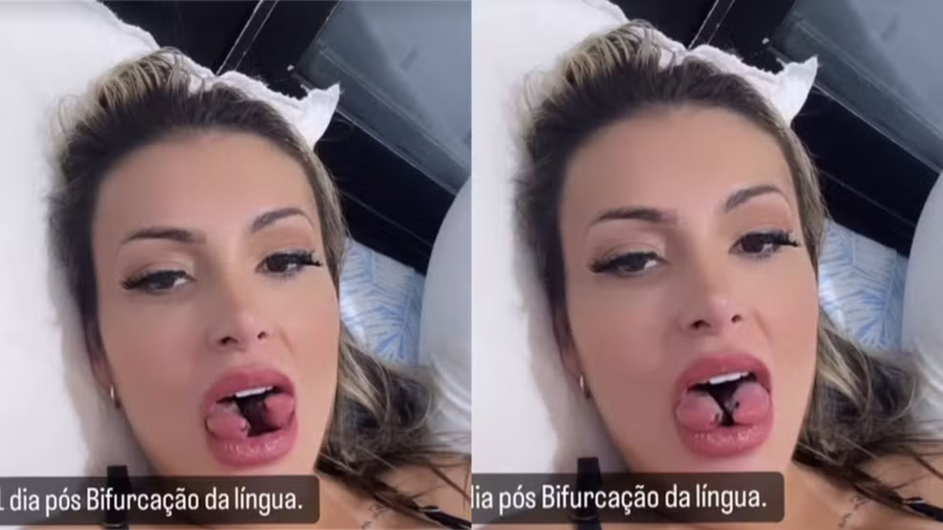 A influenciadora realizou a bifurcação da língua em 2024 e agora pretende reverter o procedimento — Foto: Reprodução/Instagram  