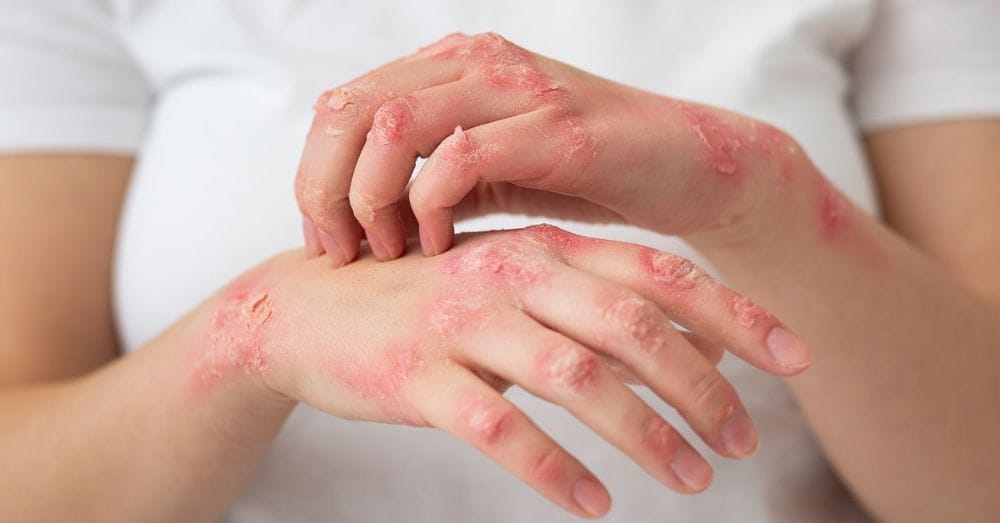 epidermólise