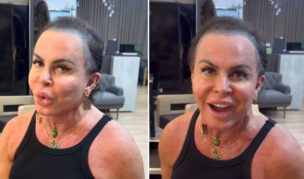 Em tratamento de alopecia, Gretchen surge sem prótese capilar na web — Foto: Reprodução/Instagram