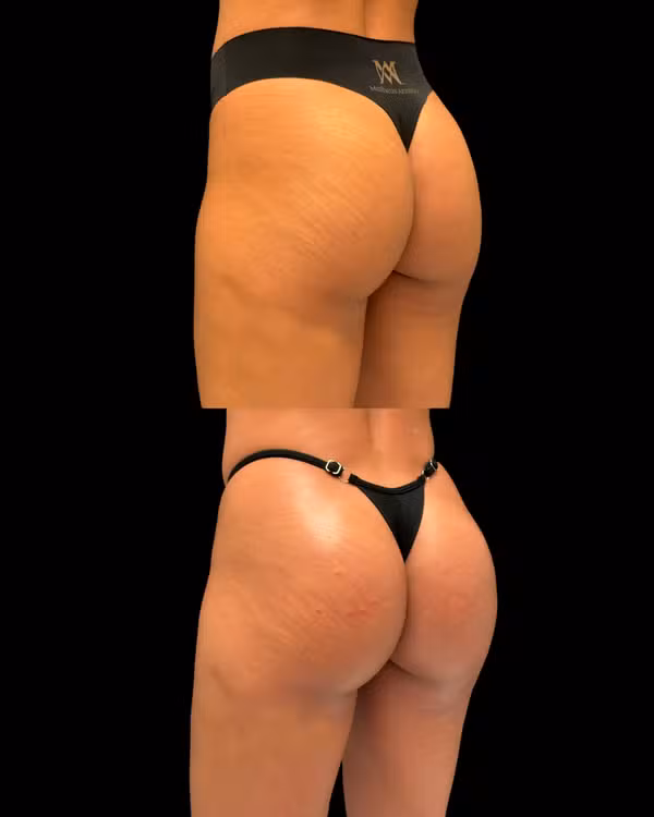"O que era bom, ficou melhor": Maxiane, do BBB 26, exibe resultado de procedimento nos glúteos