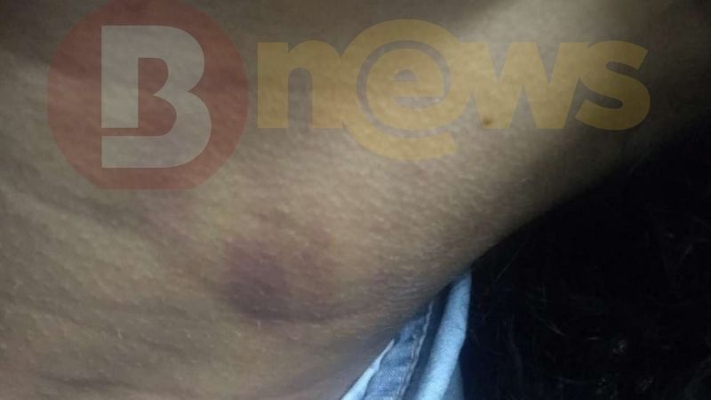 MARCA DEIXADA NO CORPO DA VÍTIMA