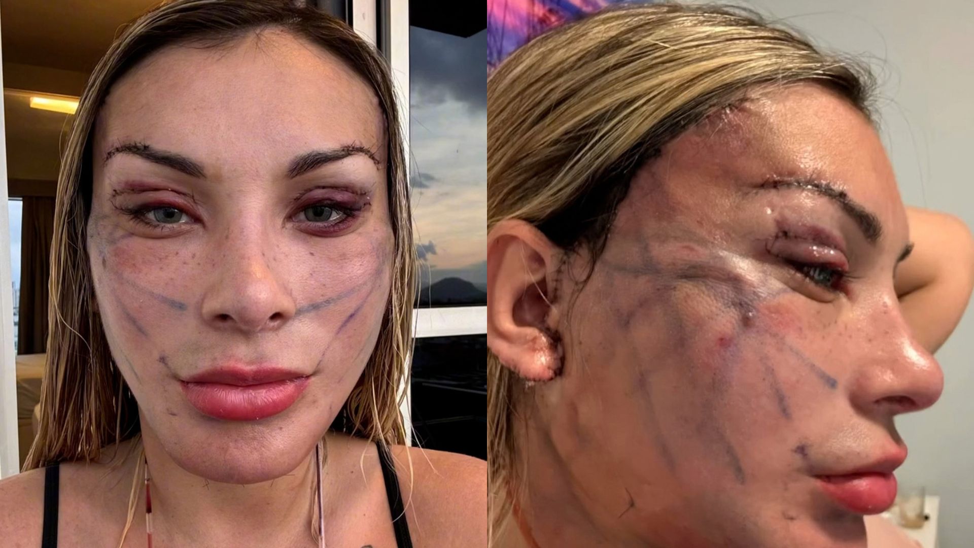 Andressa Urach mostrou detalhes do procedimento Deep Plane Facelift, técnica utilizada na transformação do rosto — Foto: Instagram