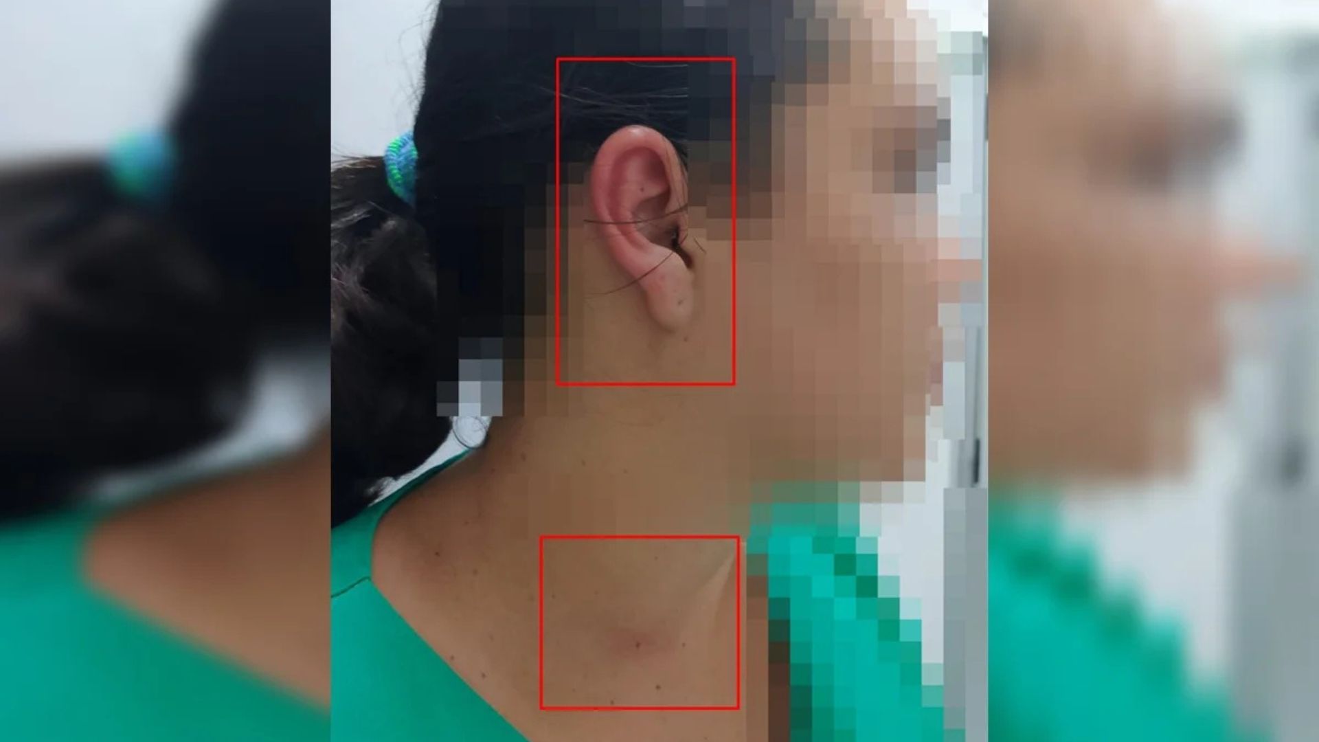 Técnica de enfermagem é agredida por paciente e acompanhante em UPA por conta de mal-entendido