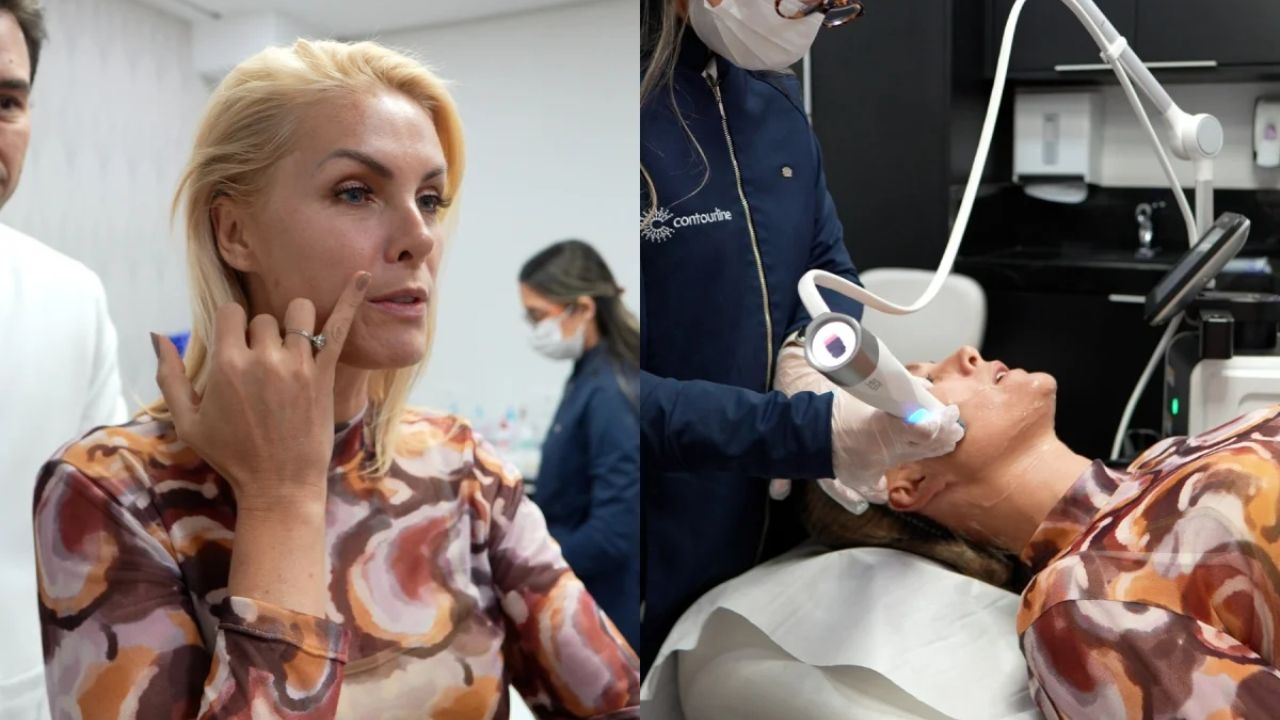Ana Hickmann aposta em procedimento estético antes de casamento com Edu Guedes