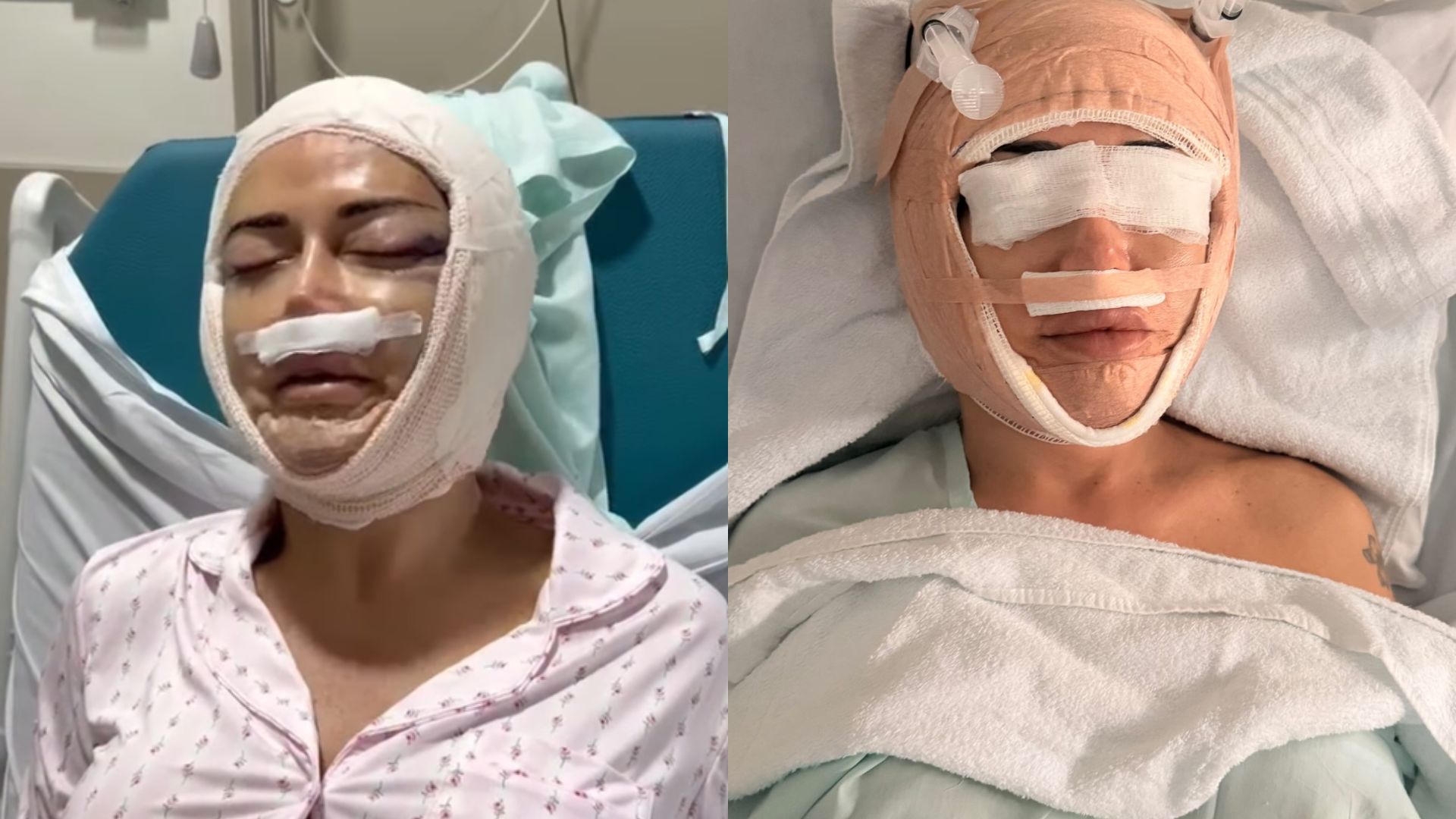 Mulher Abacaxi surpreende com transformação no rosto aos 53 anos: “Quero inspirar outras mulheres trans"