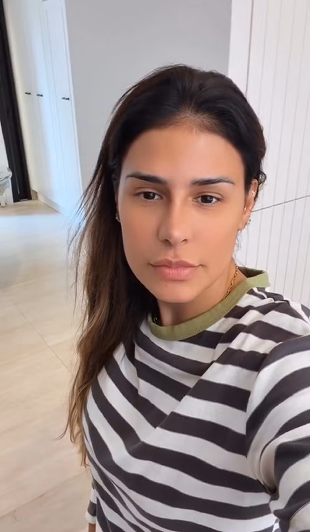Simone Mendes aparece sem curativos e revela como ficou o nariz dias depois do procedimento estético