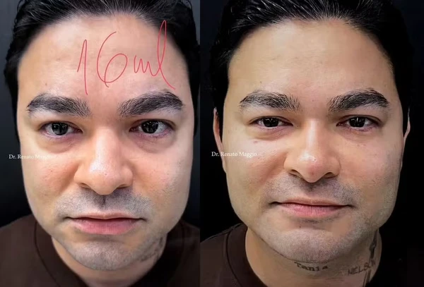 Yudi Tamashiro passa por harmonização facial; veja o antes e depois por Reprodução/Instagram