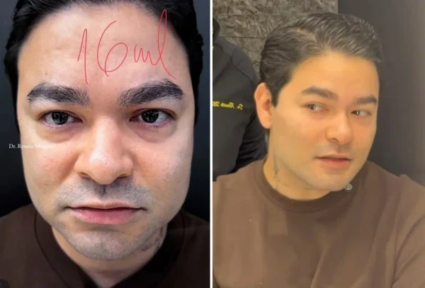 Yudi Tamashiro passa por harmonização facial; veja o antes e depois por Reprodução/Instagram