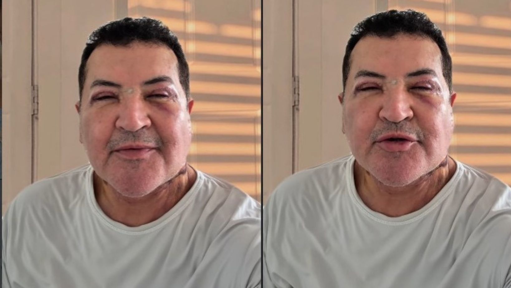 Beto Barbosa assusta fãs ao aparecer com rosto inchado e cheio de hematomas