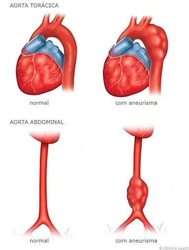 aneurisma