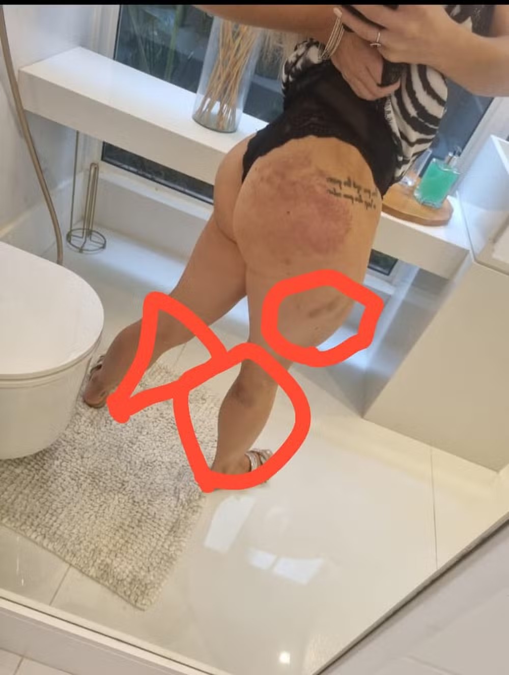 Advogada Larissa Ferrari mostrou hematomas pelo corpo ao acusar Dimitri Payet, do Vasco, de agressão — Foto: Arquivo pessoal