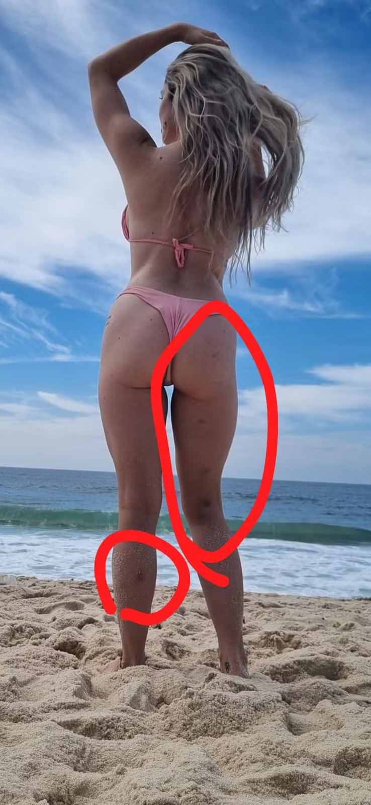 Advogada Larissa Ferrari mostrou hematomas pelo corpo ao acusar Dimitri Payet, do Vasco, de agressão — Foto: Arquivo pessoal
