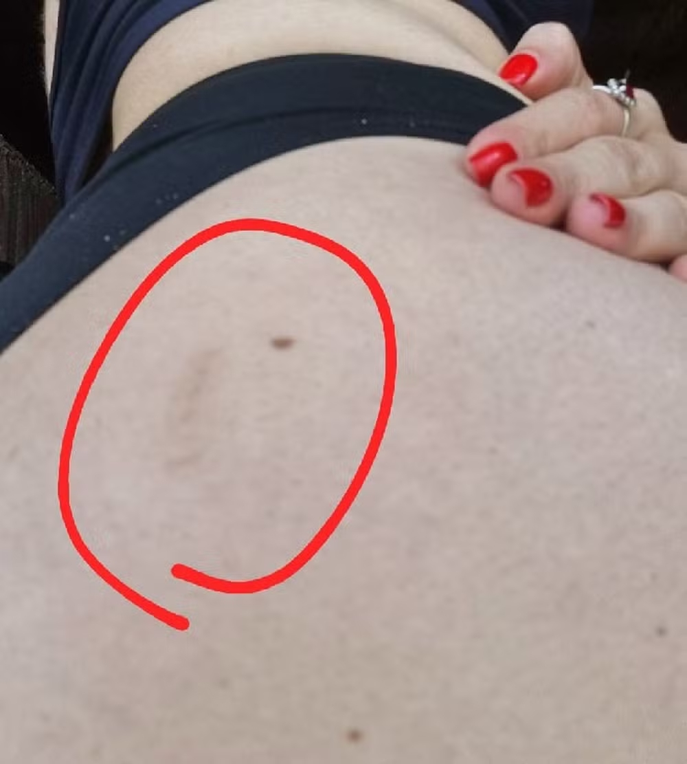 hematomas de larissa