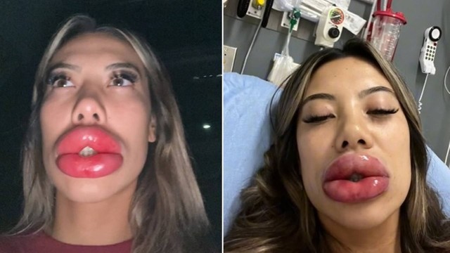 Imagem da americana durante e depois do processo quando a alergia se manifestou
