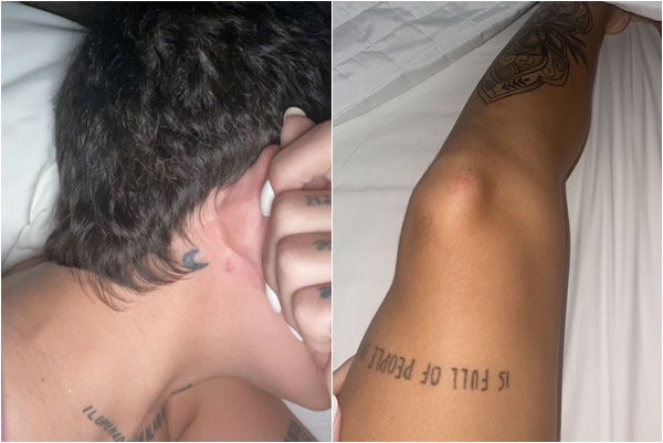 ferimento lary bottino