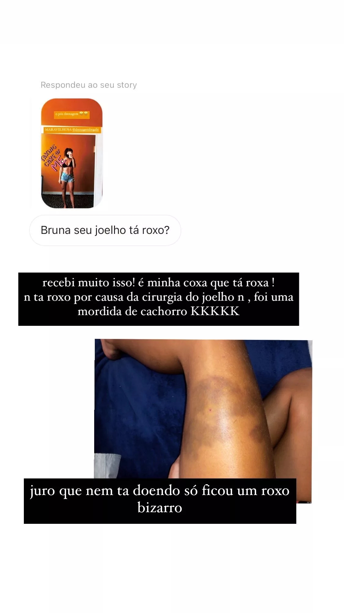 BBB23: Bruna Griphao já foi atacada por cachorro e assustou fãs com hematoma; confira imagem