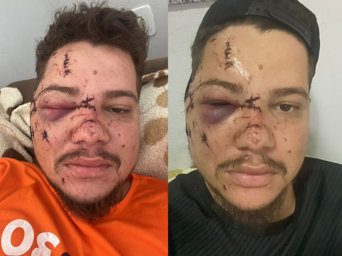 Benício, da dupla Hermes e Benício, fica com rosto desfigurado após ataque em João Pinheiro (MG) (Arquivo pessoal)