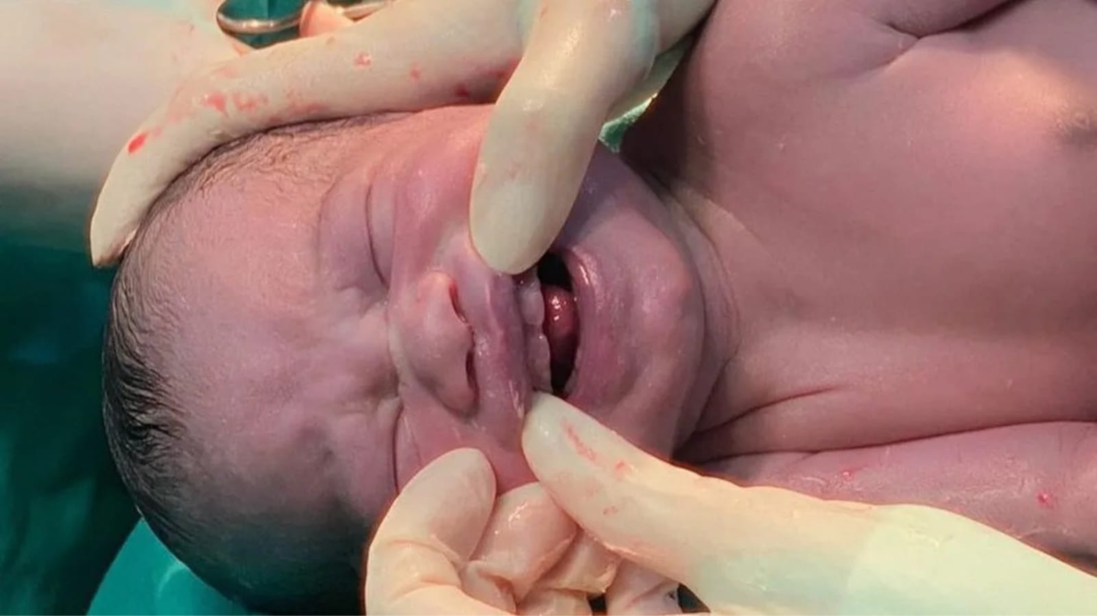 Bebê nasce com dentes de leite